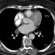 Pericardial cyst: CT - Computed tomography